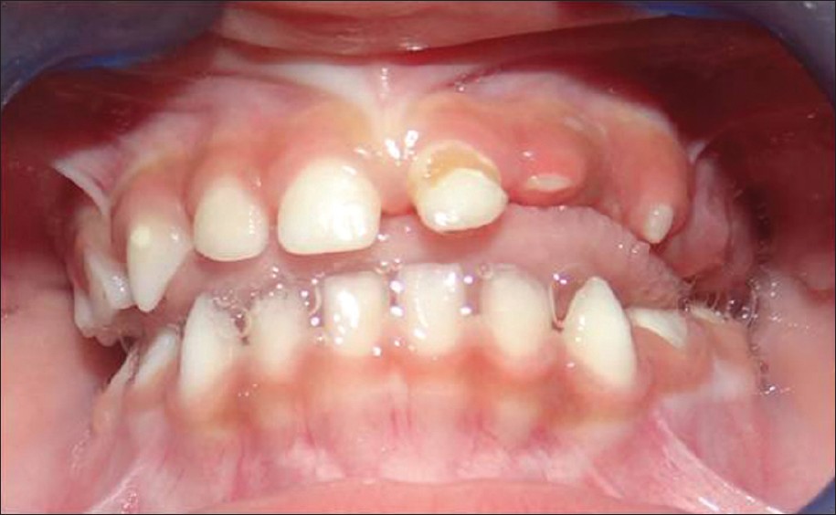 تاخیر در بیرون زدن دندان می تواند باعث ادنتوپلازی منطقه ای شود